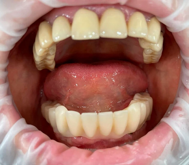 Palsa Dental Münchner Schiene(3)_700 px.jpg (Bild: Palsa Dental, Leipzig) Palsa Dental Münchner Schiene(3)_700 px.jpg (Bild: Palsa Dental, Leipzig)